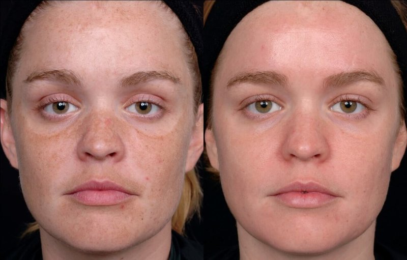 Før og etter laser ansiktsrensing