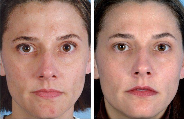 Avant et après le nettoyage du visage sous vide