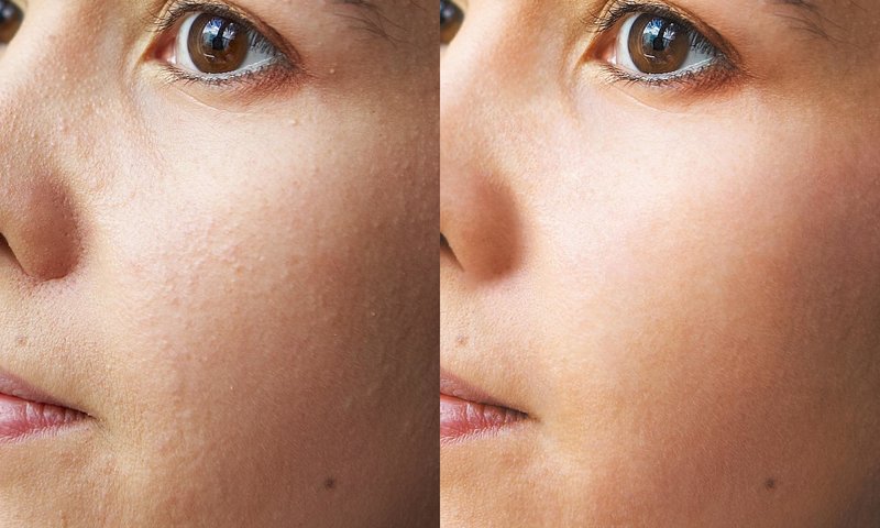 Avant et après le nettoyage du visage par ultrasons