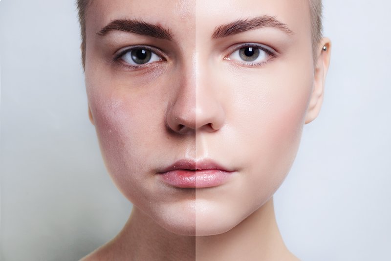 Avant et après le nettoyage du visage