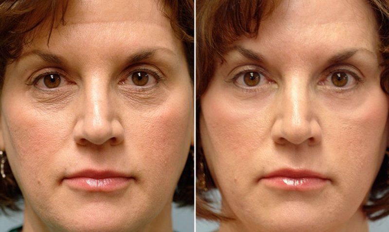 Correction du visage avec RF lifting 10 procédures